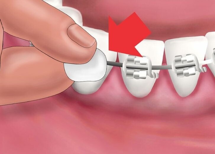 Vaškas su veidrodėliu Ortho (spec.nešiojantiems ortodontinius prietaisus) G.U.M.® (723) kaina ir informacija | Dantų šepetėliai, pastos | pigu.lt