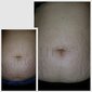 Rinkinys strijoms Ame Pure® Body Basic | Stretch Marks Kit kaina ir informacija | Anticeliulitinės, stangrinamosios priemonės | pigu.lt